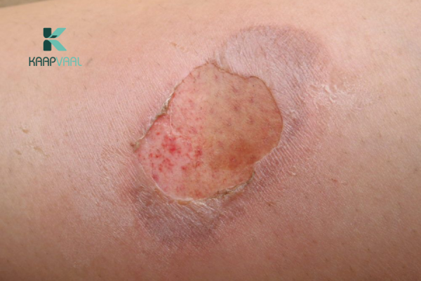Phân loại mức độ nặng - nhẹ của vết bỏng