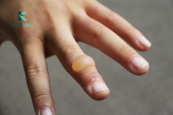 Bọng Nước Khi Bị Bỏng