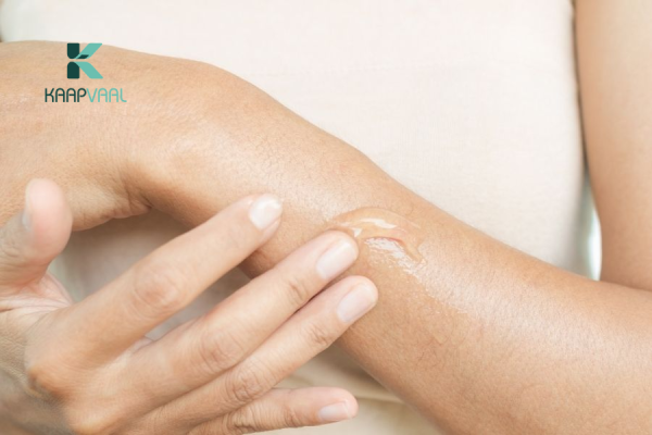 Có thể sử dụng mỡ trăn cho các vết bỏng nhẹ