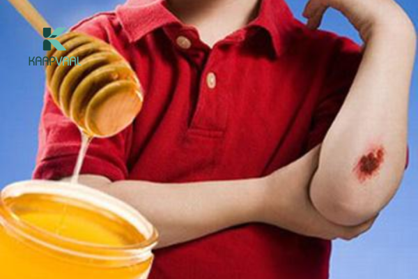 Hướng dẫn bôi mật ong trị bỏng đúng cách, hiệu quả