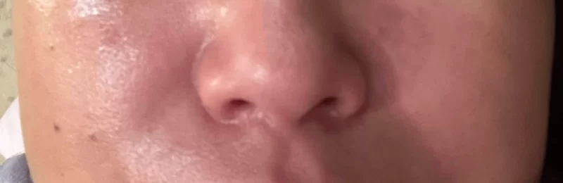da bị bỏng rát
