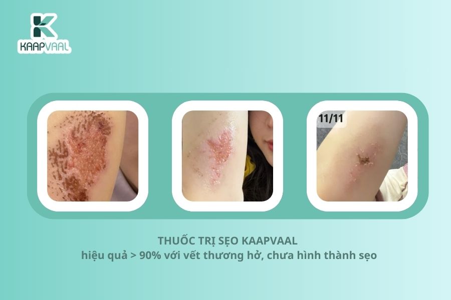 Kaapvaal - Thuốc trị sẹo hàng đầu ứng dụng Công nghệ Y học tái tạo