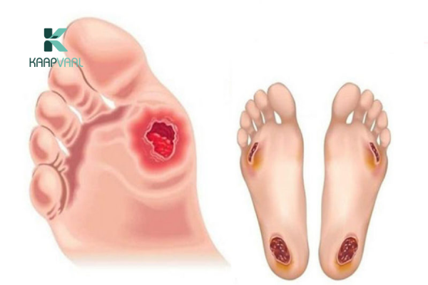 Các vết lở loét ở bệnh nhân tiểu đường
