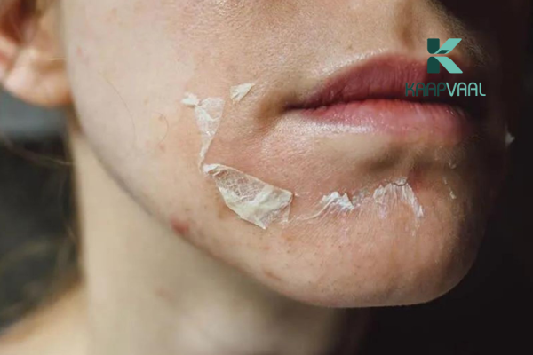 Triệu chứng nhận biết da bị bỏng khi peel
