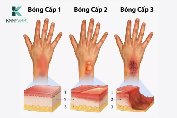 Các cấp độ bỏng