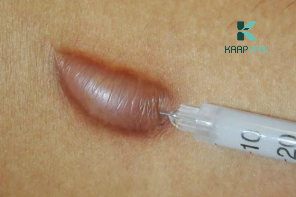 Tiêm corticosteroid