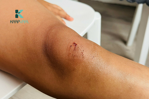 Nguyên nhân thường gặp gây ra vết thương ở đầu gối