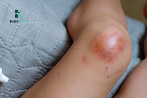 Đánh giá mức độ nghiêm trọng của vết thương