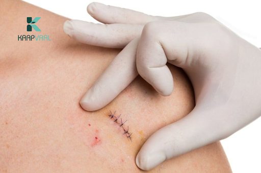 Trong một số trường hợp, bác sĩ có thể đề nghị để hở vết thương khâu