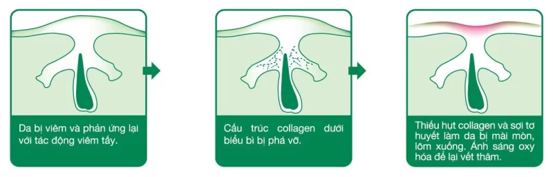 quy trình hình thành sẹo mụn